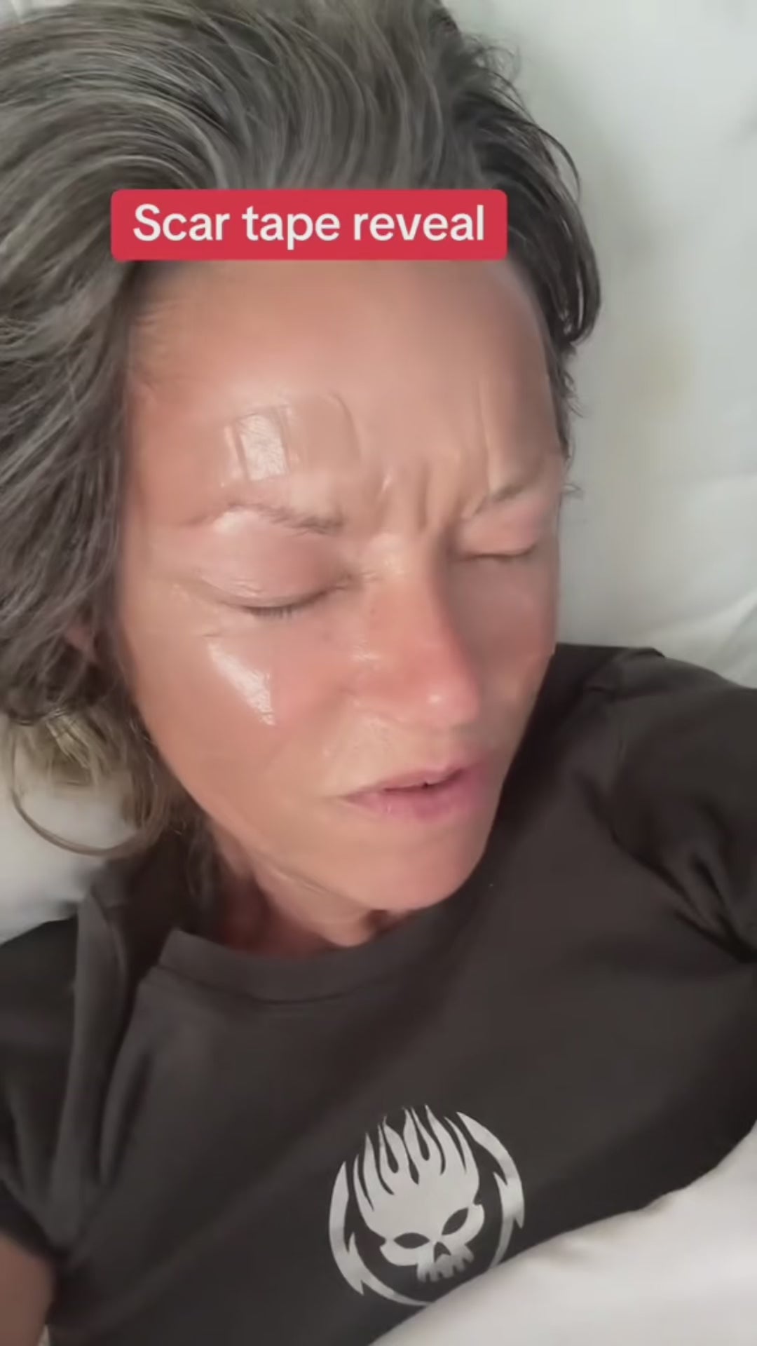 Collagen Scar Tape™ video