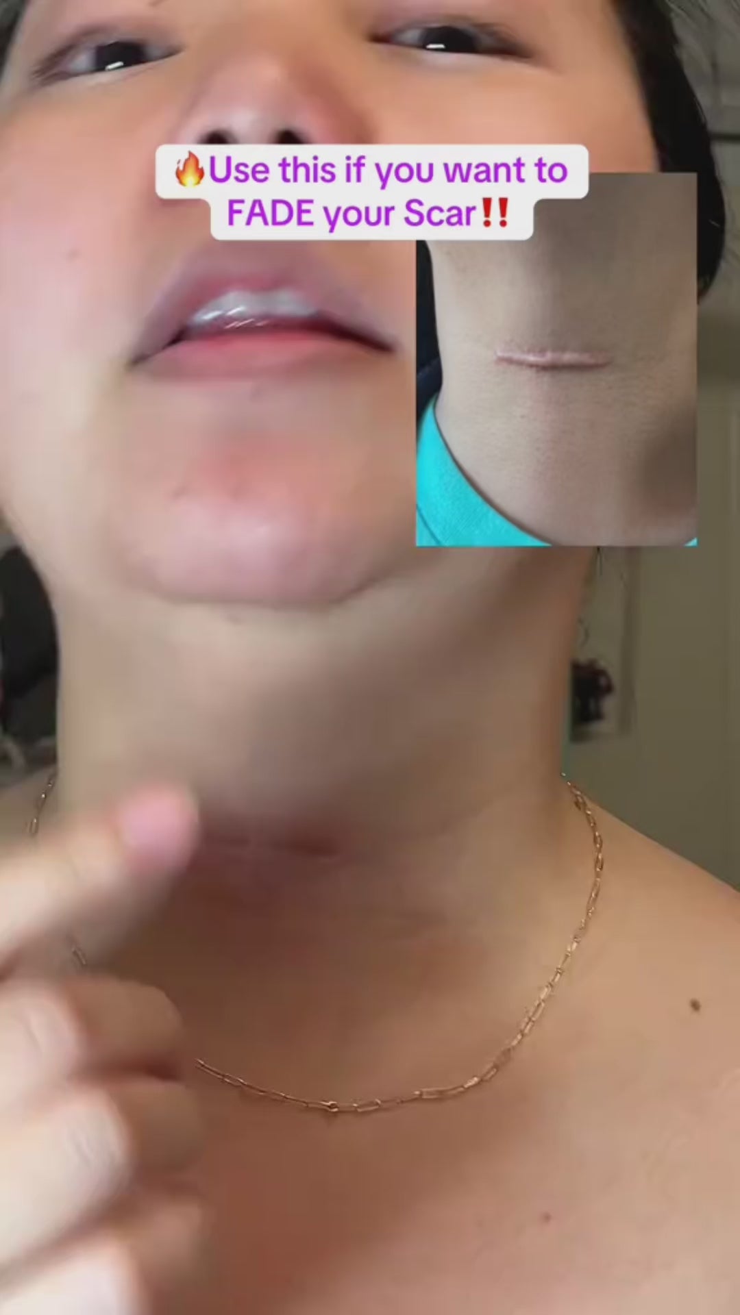 Collagen Scar Tape™ video